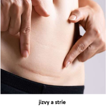 Jizvy a strie