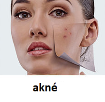 Akné